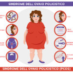 Schema che illustra i sintomi della sindrome dell'ovaio policistico