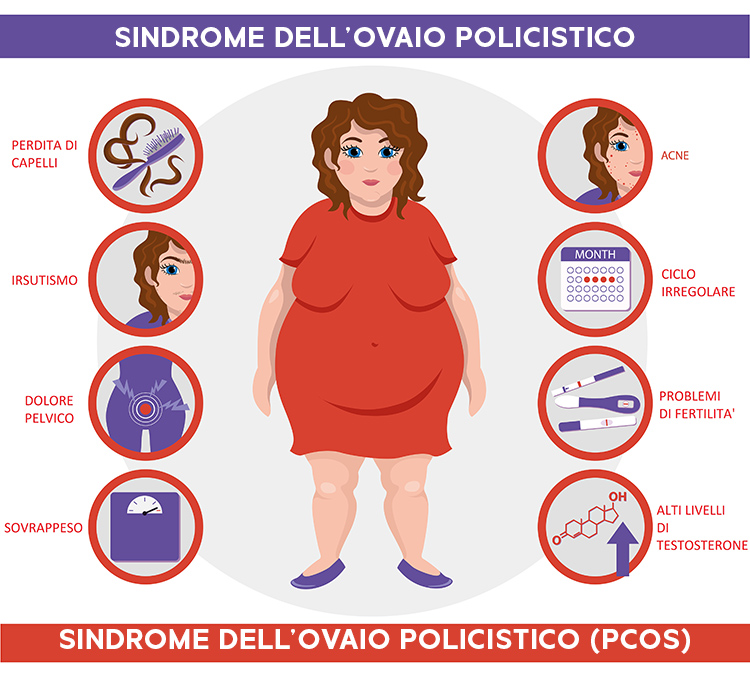 Schema che illustra i sintomi della sindrome dell'ovaio policistico